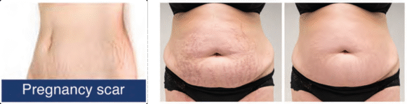 Radiant Aurora Microneedling