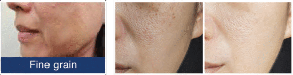 Radiant Aurora Microneedling