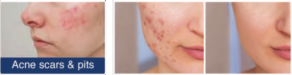 Radiant Aurora Microneedling