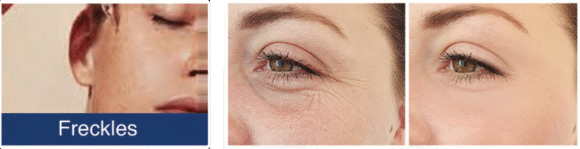 Radiant Aurora Microneedling