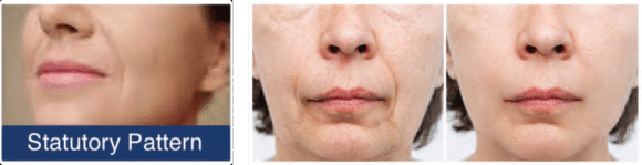 Radiant Aurora Microneedling