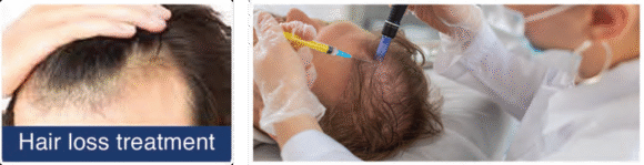 Radiant Aurora Microneedling