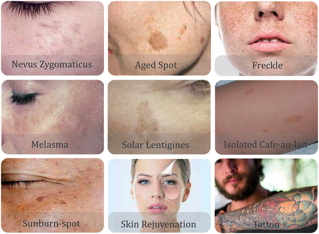 Radiant Quantum - Treatment Photos