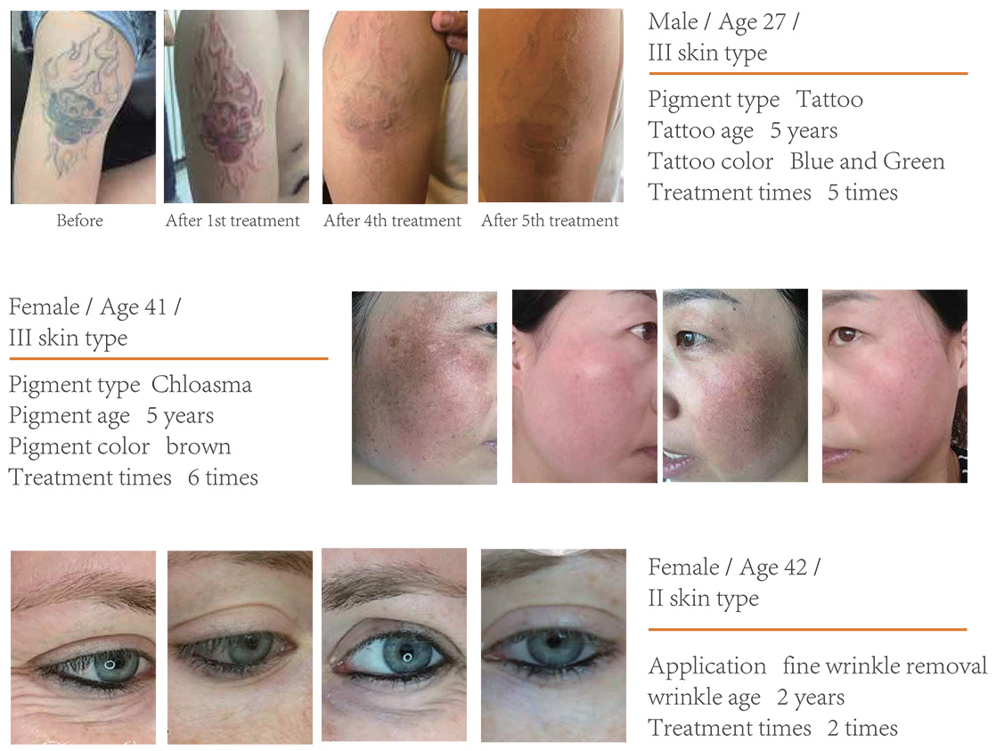 Radiant Quantum - Treatment Photos