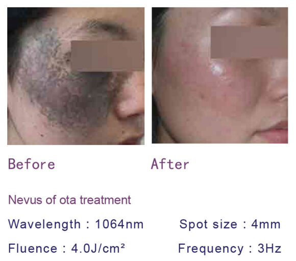 radiant-spectra-nd-yag-laser-image-01