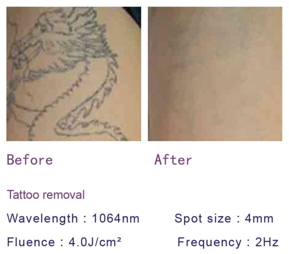 radiant-spectra-nd-yag-laser-image-02